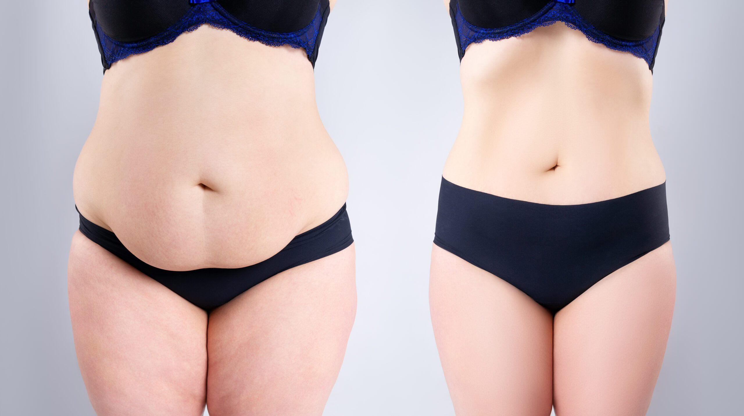 Body Contouring before and after treatment in Leominster, MA | Opulent Aesthetics and Wellness